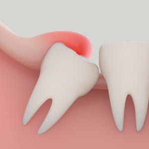 dịch vụ nhổ răng khôn nha khoa gia đình bắc ninh