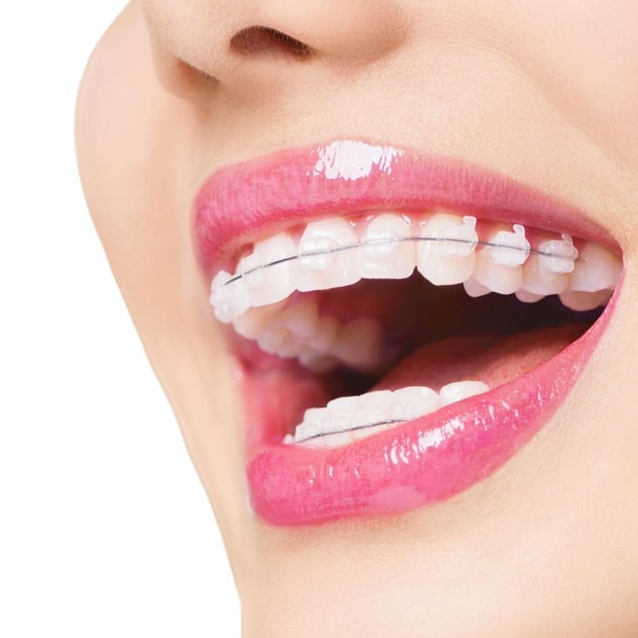 dịch vụ niềng răng chỉnh nha nha khoa gia đình bắc ninh