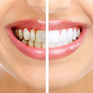 dịch vụ tẩy trắng răng nha khoa gia đình bắc ninh