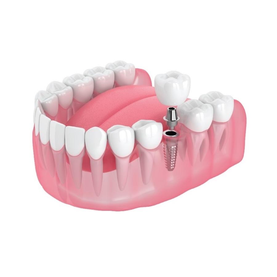 dịch vụ trồng răng implant nha khoa gia đình bắc ninh