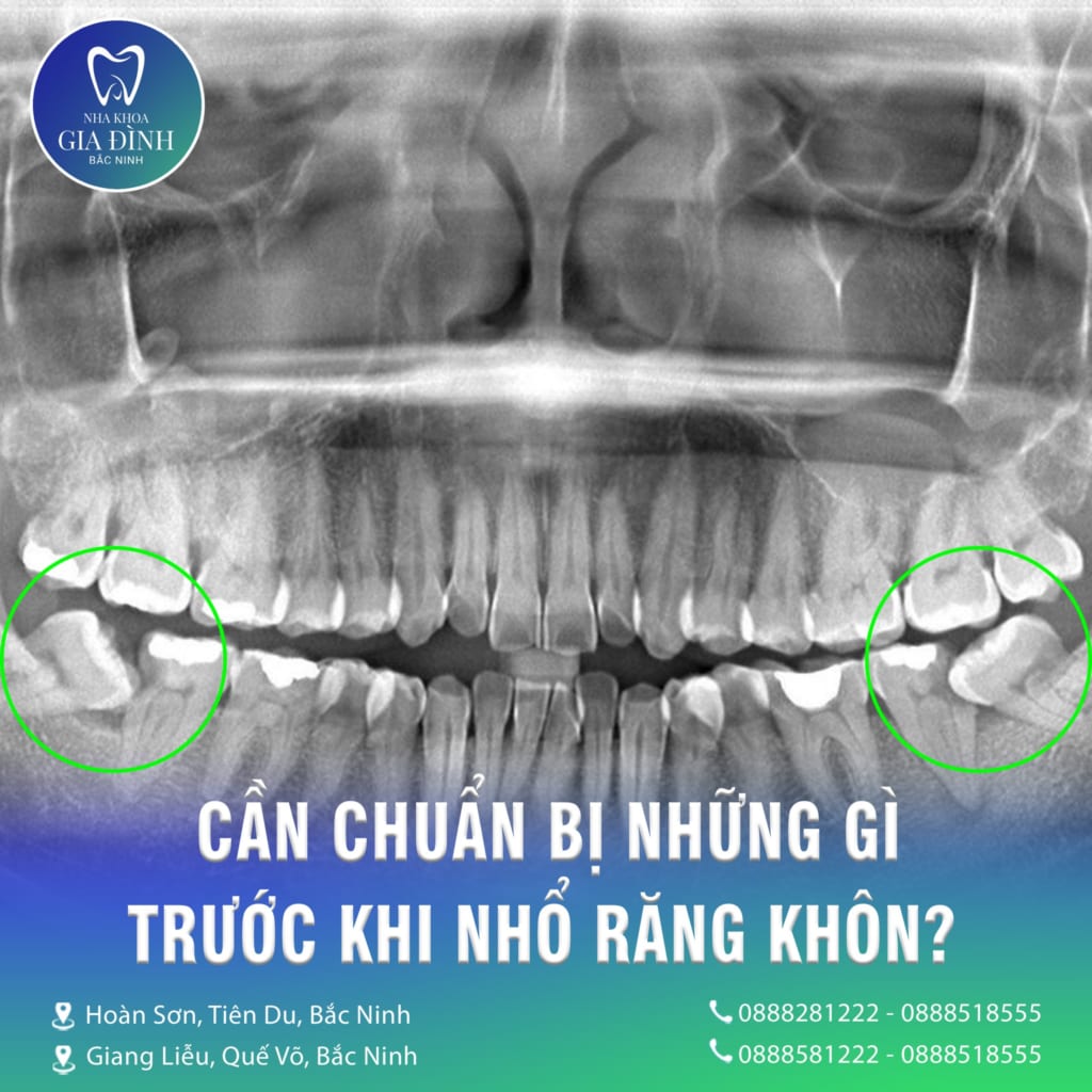 can chuan bi nhung gi truoc khi nho rang khon tai bac ninh