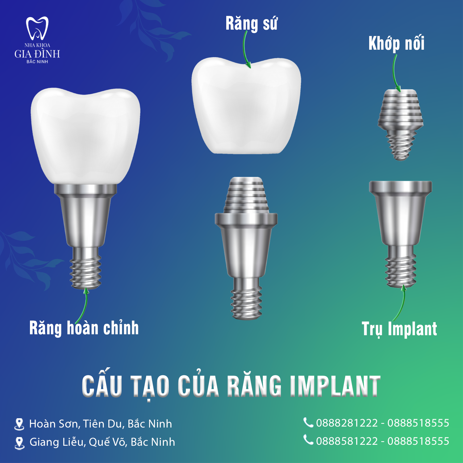 cau tao cua rang implant tai nha khoa gia dinh bac ninh