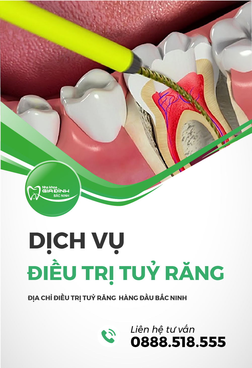 dich vụ dieu tri tuy rang tai bac ninh - nha khoa gia dinh bac ninh