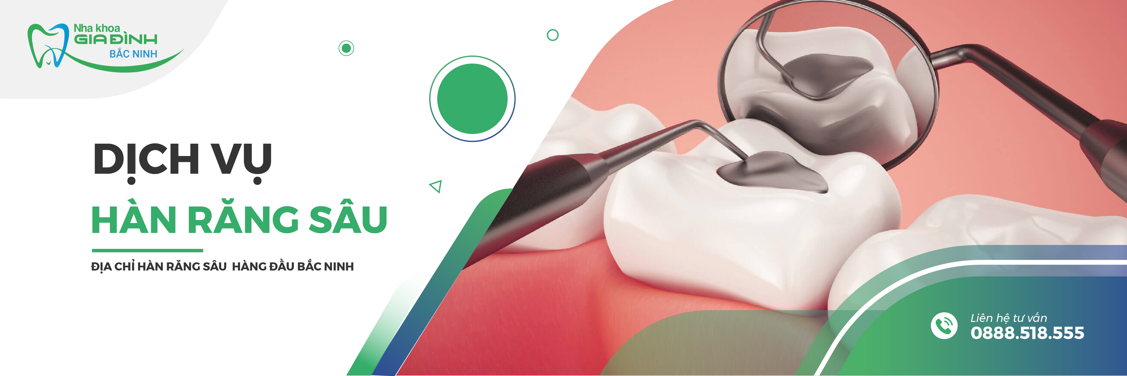 dich vu han rang sau tai nha khoa gia dinh bac ninh uy tin