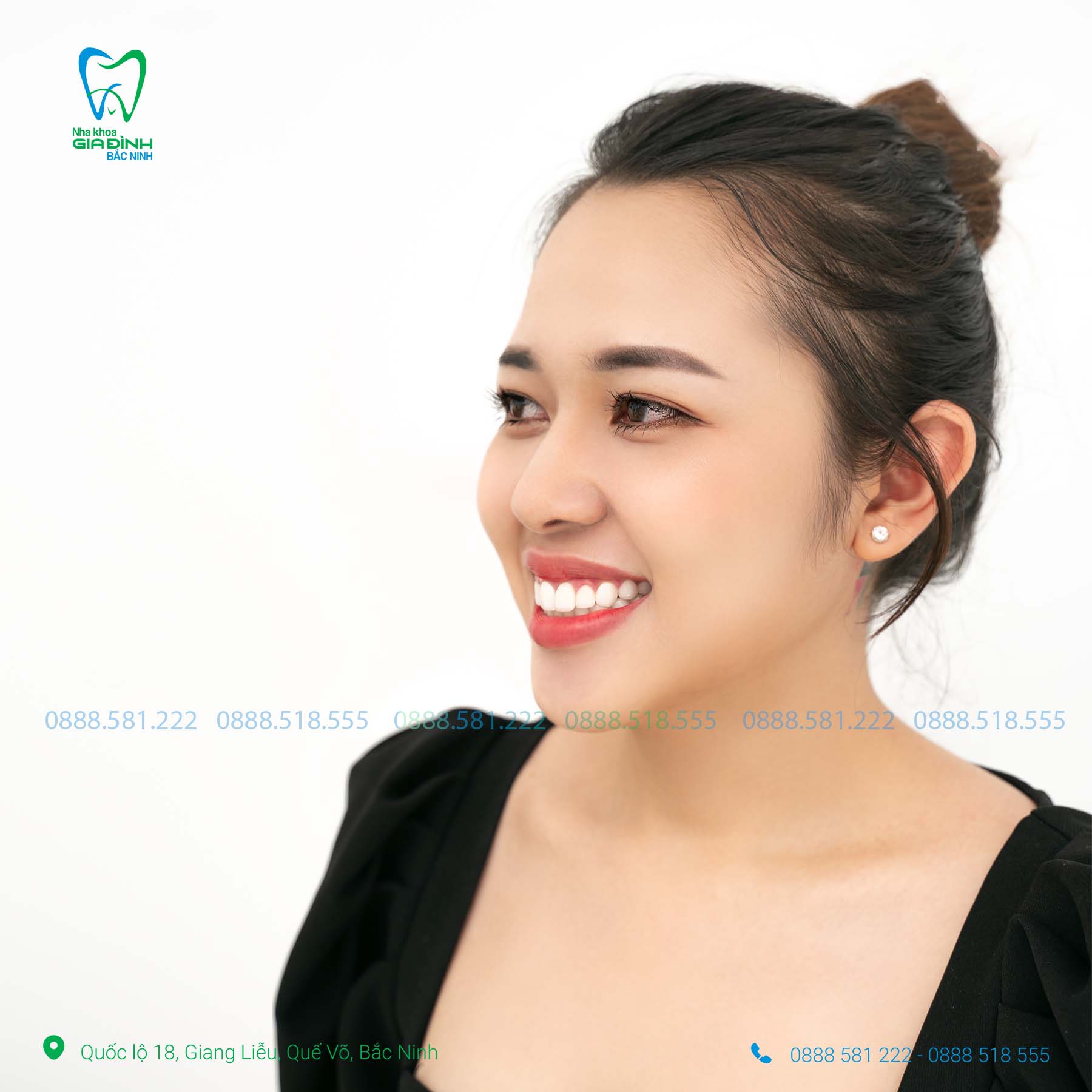 tay trang rang tai bac ninh het bao nhieu tien