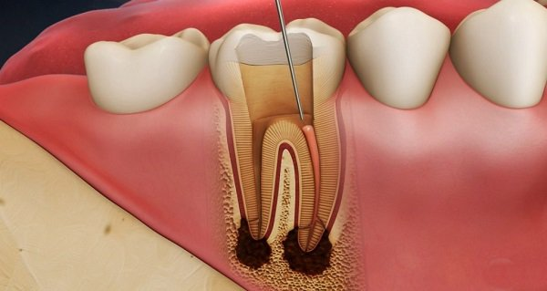 Địa chỉ điều trị tuỷ răng tại Tiên Du, Bắc Ninh an toàn, giá rẻ 1 Điều trị tủy răng khỏi viêm