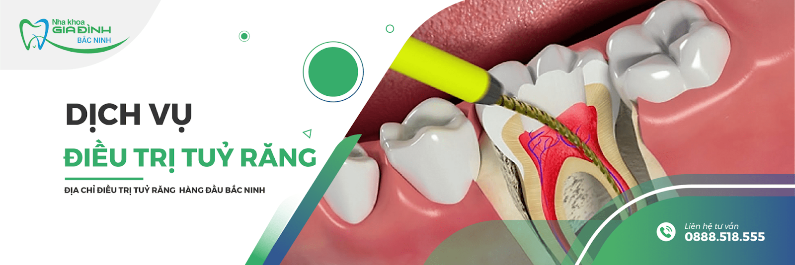 Điều trị tuỷ răng tại Từ Sơn ở địa chỉ nào đáng tin cậy? 1 Điều trị tủy răng là việc làm cần thiết để loại bỏ răng sâu, vùng viêm nhiễm