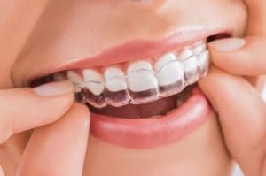 Niềng răng dùng khay trong suốt  Invisalign