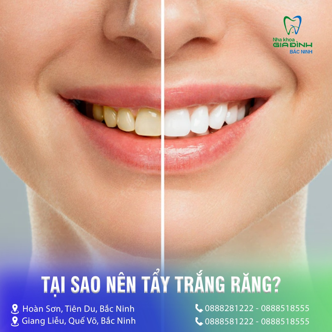 Địa chỉ tẩy trắng răng tại Quế Võ, Bắc Ninh uy tín nhất 3 Dịch vụ tẩy trắng răng tại Quế Võ uy tín, chất lượng