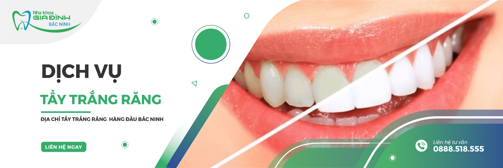 Địa chỉ tẩy trắng răng tại Tiên Du chuyên nghiệp hàng đầu 1 Dịch vụ tẩy trắng răng tại Tiên Du đang được nhiều khách hàng ưa chuộng