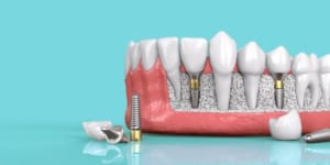 Trồng răng Implant tại Nha Khoa Gia Đình BN