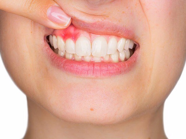 Bọc răng sứ bị sưng lợi có nguy hiểm không? 2 Bọc răng sứ bị sưng lợi là do đâu?