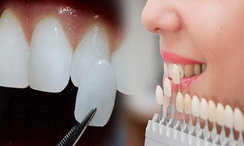 Bọc răng sứ giá bao nhiêu tại Nha Khoa Gia Đình Bắc Ninh 2 Bọc răng sứ giá bao nhiêu khi bọc sứ không kim loại