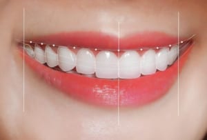 Tại sao lựa chọn Nha Khoa Gia Đình Bắc Ninh để bọc răng sứ