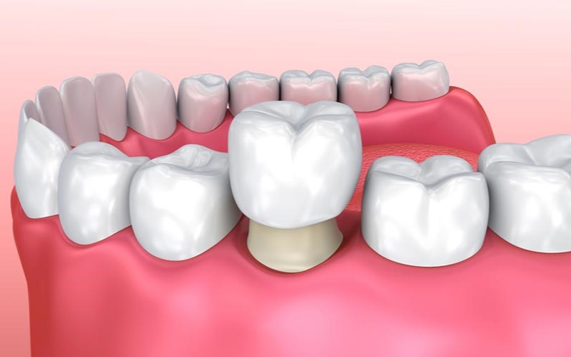 Bọc răng sứ giá bao nhiêu tại Nha Khoa Gia Đình Bắc Ninh 1 Bọc răng sứ giá bao nhiêu tại Nha Khoa Gia Đình Bắc Ninh