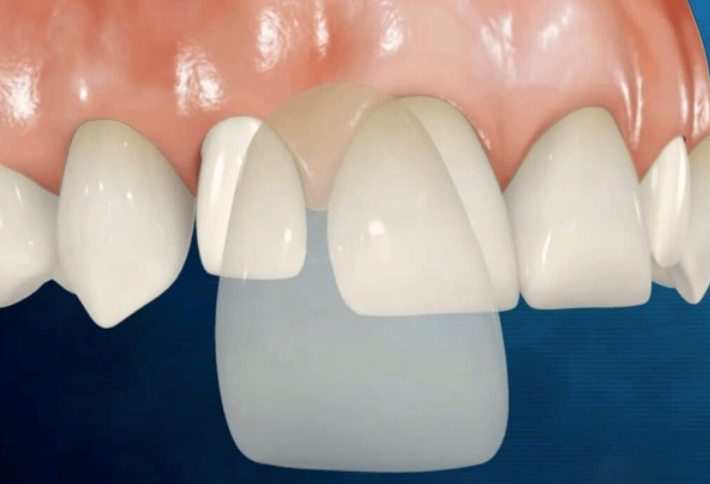 Bọc răng sứ không mài là gì? Có nên làm bọc răng sứ không mài không? 2 Dán sứ Veneer là phương pháp hiệu quả nhưng không phải ai cũng phù hợp