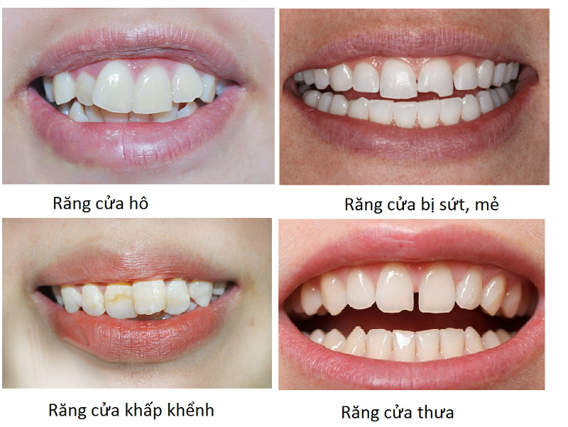 Bọc răng sứ là gì? 4 công dụng của việc bọc răng sứ 2 Những trường hợp nào nên bọc răng sứ