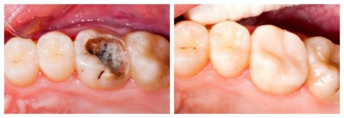 Có nên bọc răng sứ răng số 6 không? Cần lưu ý gì? 2 Răng số 6 có thể bị sâu, tổn thương nếu chăm sóc không đúng cách