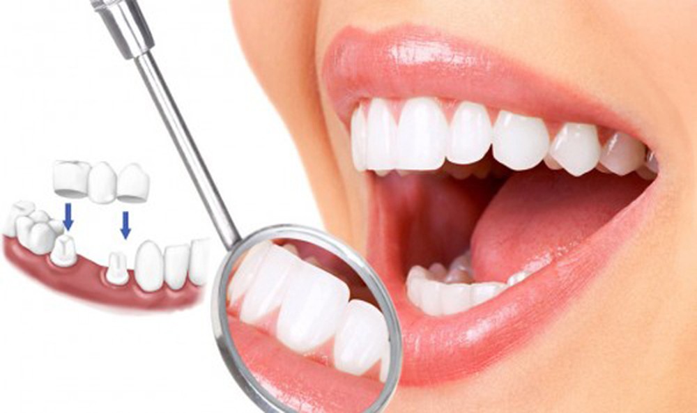 Có nên bọc răng sứ răng số 6 không? Cần lưu ý gì? 3 Tính toán chi phí bọc răng sứ răng số 6 phù hợp