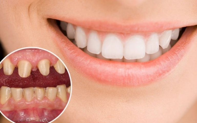 Có nên bọc răng sứ nguyên hàm không? Ưu và nhược điểm 2 Có nên bọc răng sứ nguyên hàm không? Câu trả lời là có