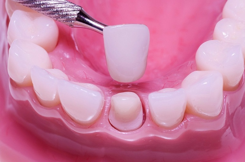 Có nên bọc răng sứ nguyên hàm không? Ưu và nhược điểm 1 Bọc răng sứ nguyên hàm