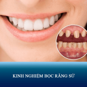 Nên khám bệnh về răng miệng trước khi bọc răng sứ
