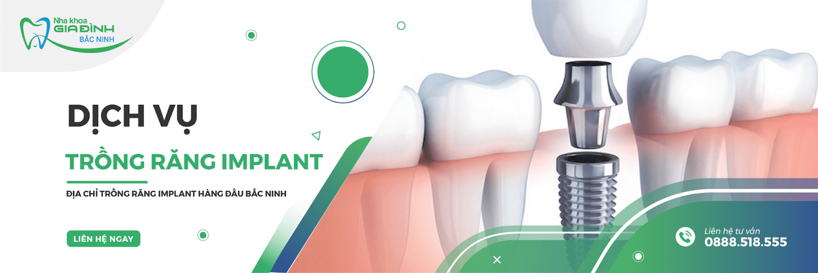 Có nên trồng răng implant? Nên trồng răng implant tại đâu? 3 Trồng răng implant chất lượng tại Nha Khoa Gia Đình Bắc Ninh