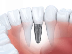Nha Khoa Gia Đình Bắc Ninh thực hiện trồng răng implant theo quy trình chuyên nghiệp