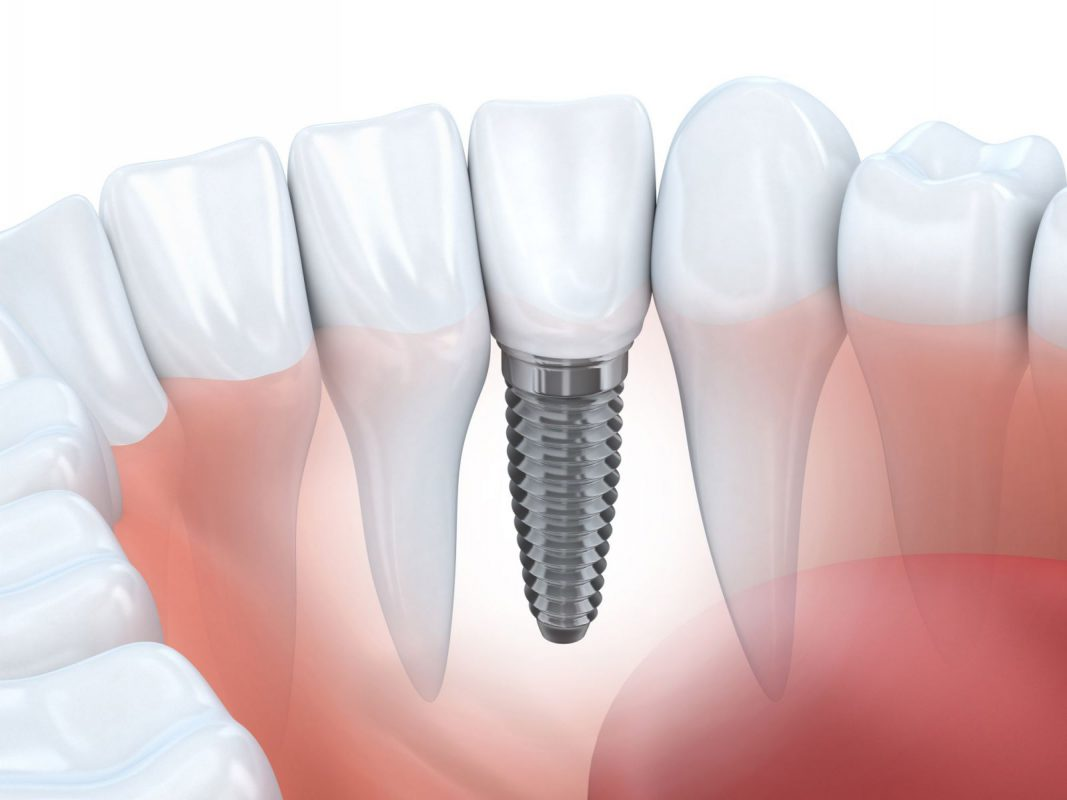 Có nên trồng răng implant? Nên trồng răng implant tại đâu? 4 Nha Khoa Gia Đình Bắc Ninh thực hiện trồng răng implant theo quy trình chuyên nghiệp