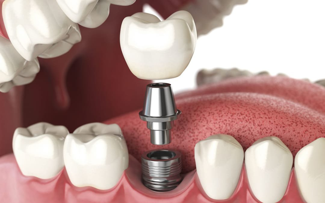 Có nên trồng răng implant? Nên trồng răng implant tại đâu? 1 Dịch vụ trồng răng implant được nhiều khách hàng lựa chọn