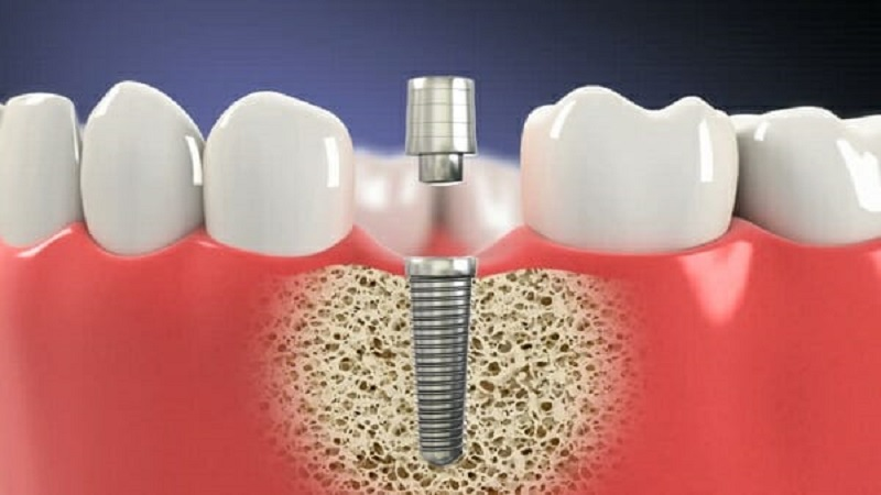 Giá trồng răng Implant Hàn Quốc có cao như lời đồn? 2 Chi phí khi trồng răng Implant Hàn Quốc có cao không?