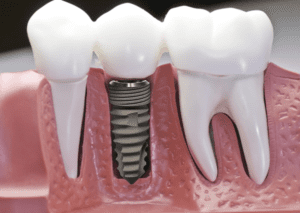 Giá trồng răng Implant Hàn Quốc như thế nào?