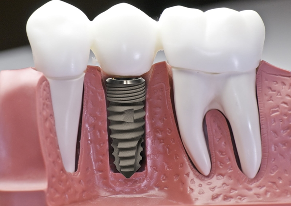 Giá trồng răng Implant Hàn Quốc có cao như lời đồn? 1 Giá trồng răng Implant Hàn Quốc như thế nào?