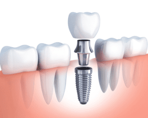 Kinh nghiệm hồi phục nhanh sau khi trồng implant 