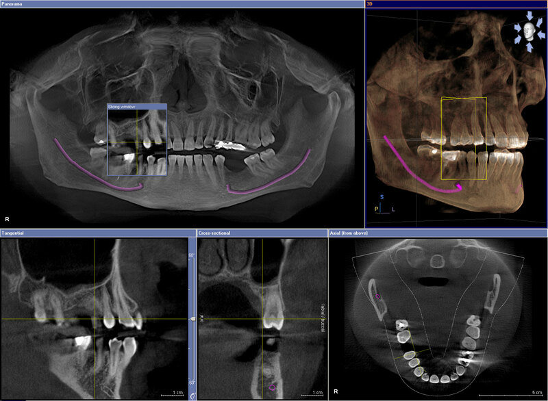 Những lưu ý khi trồng răng implant nhất định không được bỏ qua 1 City kiểm tra a răng và xương trước khi trồng implant
