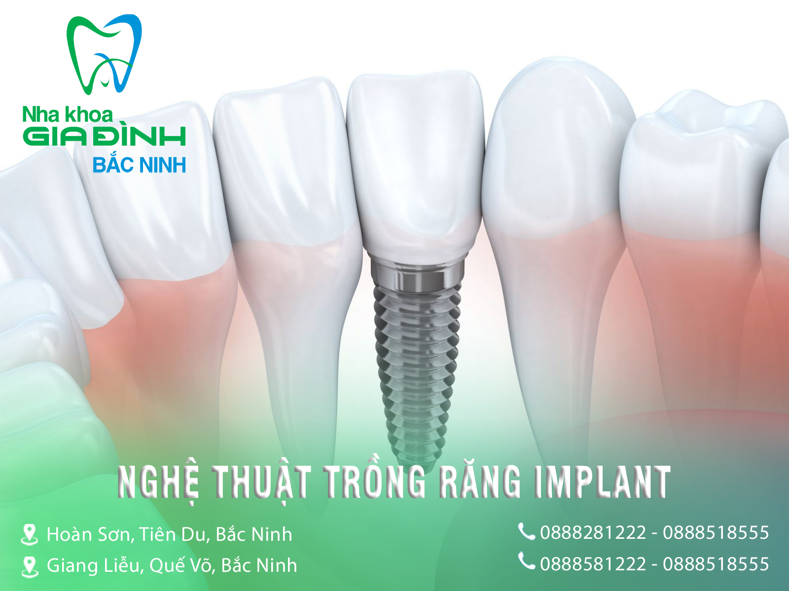 Nên trồng răng Implant ở đâu? Đánh giá uy tín theo tiêu chí nào? 3 Nha khoa Gia Đình có các bác sĩ có tay nghề và nghệ thuật trồng răng Implant vững vàng