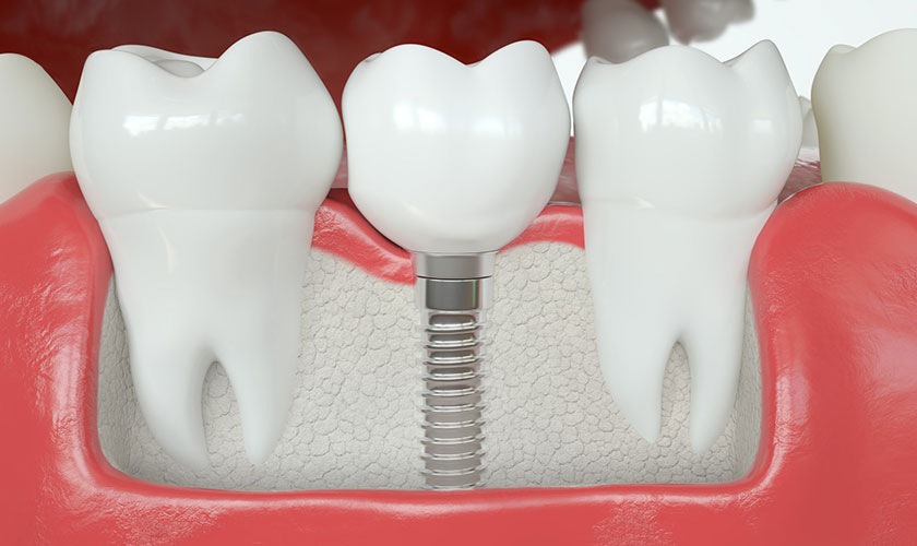 Nên trồng răng Implant ở đâu? Đánh giá uy tín theo tiêu chí nào? 1 Nên trồng răng Implant ở đâu? Đánh giá uy tín theo tiêu chí nào?