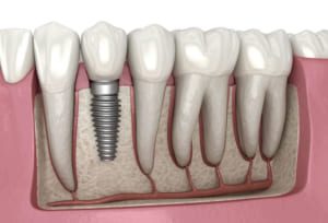 Trồng răng Implant bao lâu thì ăn được?