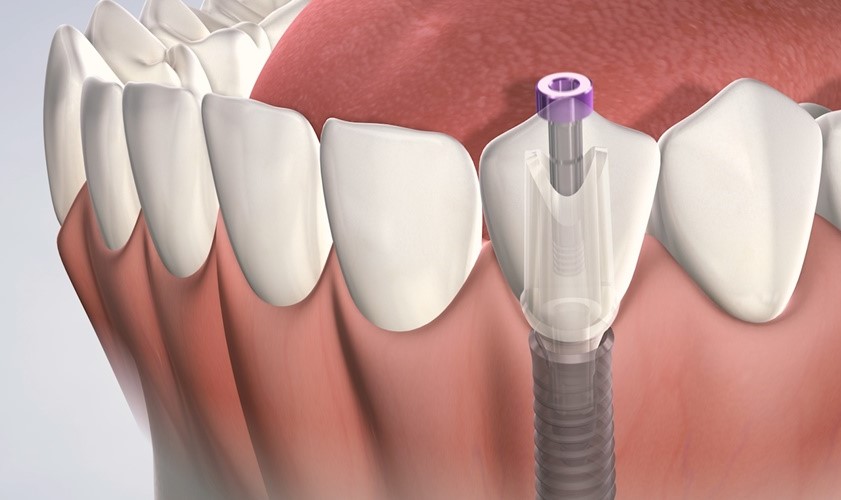 Giải đáp thắc mắc: Trồng răng implant bao lâu thì lành? 2 Trồng răng implant bao lâu thì lành?