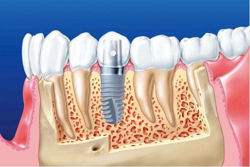 Trồng răng implant bị tiêu xương và những điều cần biết 3 Cần thăm khám nha khoa kỹ lưỡng trước khi trồng implant