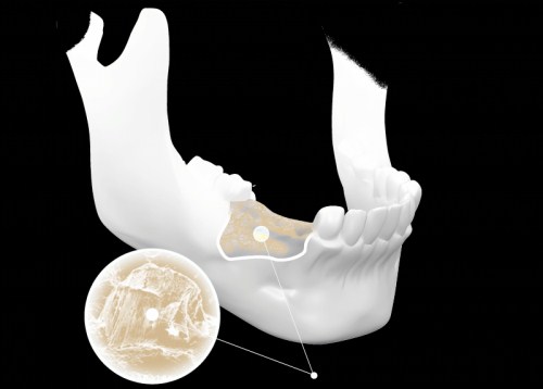 Trồng răng implant bị tiêu xương và những điều cần biết 1 Tiêu xương hàm là một vấn đề nha khoa đặc biệt