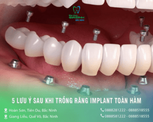 Trồng răng implant không có những biến chứng xảy ra 