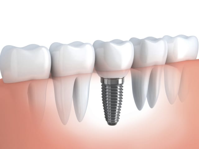 Trồng răng implant có nguy hiểm không và cần lưu ý những gì? 1 Trồng răng implant có nguy hiểm không?