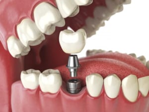 Trồng răng Implant là gì được nhiều người quan tâm