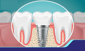 Trụ Implant Tekka thiết kế trụ thay thế chân răng chắc chắn 