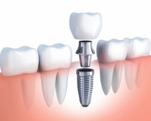 Phương pháp trồng răng implant mất bao lâu?