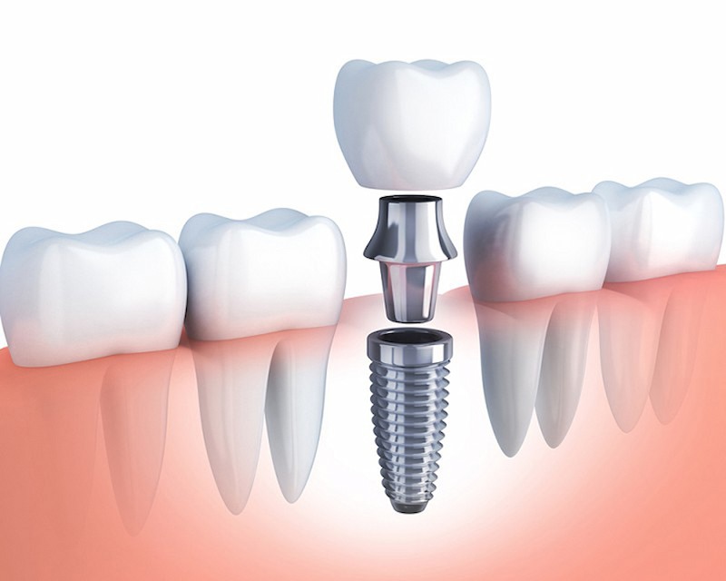 Trồng răng implant mất bao lâu? Có thể rút ngắn thời gian không? 1 Phương pháp trồng răng implant mất bao lâu?