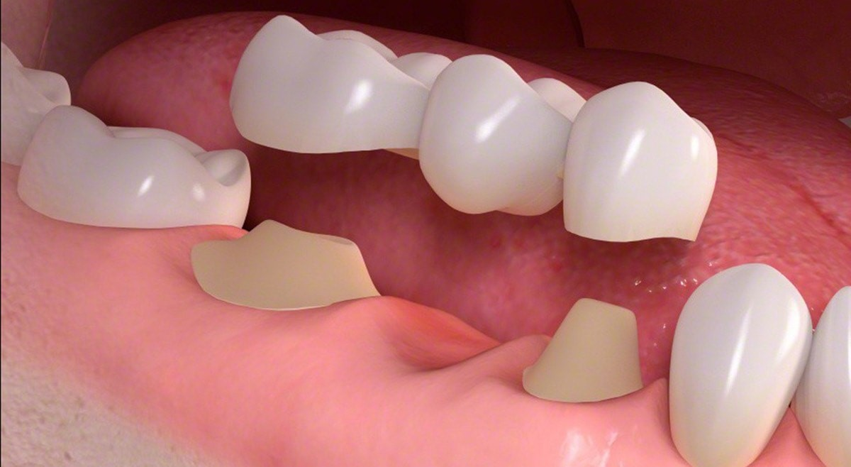 Trồng răng Implant như thế nào, một vài ưu và nhược điểm 3 Những điều kiện bạn cần phải đáp ứng khi trồng răng Implant
