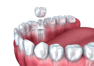 Những gì bạn cần phải đáp ứng khi trồng răng Implant để đem lại hiệu quả?