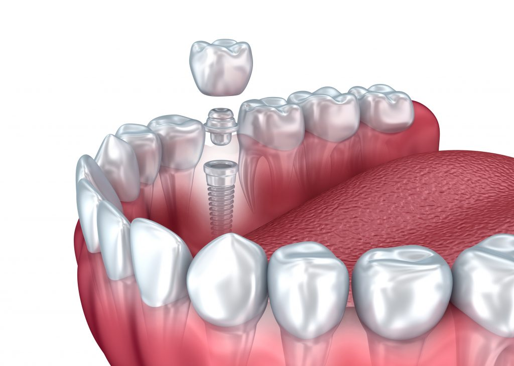 Trồng răng Implant như thế nào, một vài ưu và nhược điểm 4 Những gì bạn cần phải đáp ứng khi trồng răng Implant để đem lại hiệu quả?